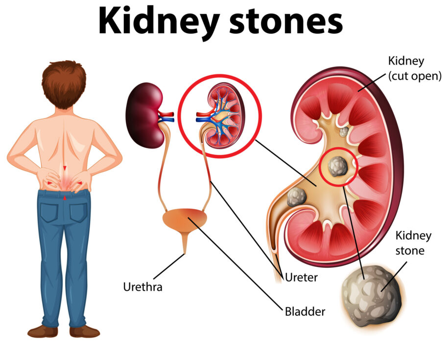 Naturopathy-kidney-treatment